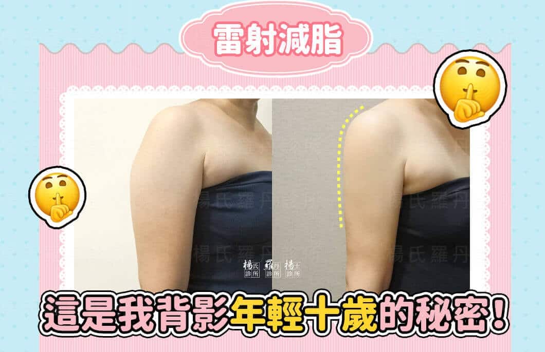 【雷射減脂】消除手臂贅肉，是我背影年輕十歲的秘密！